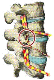 Subluxation of the spine
